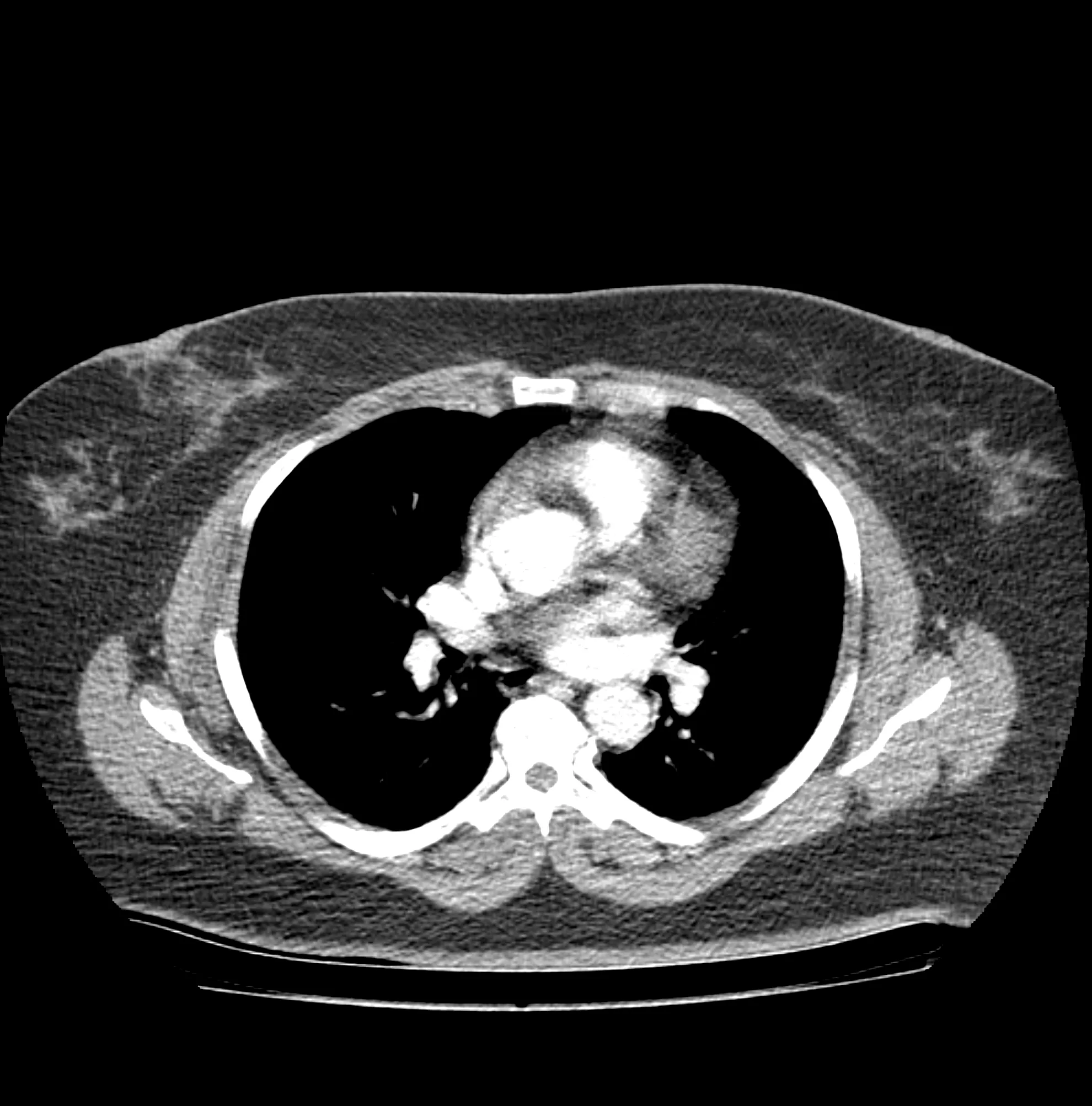 Corte axial de un estudio de tomografía computarizada toracoabdominal, usado como referencia visual del tablero de regiones.
