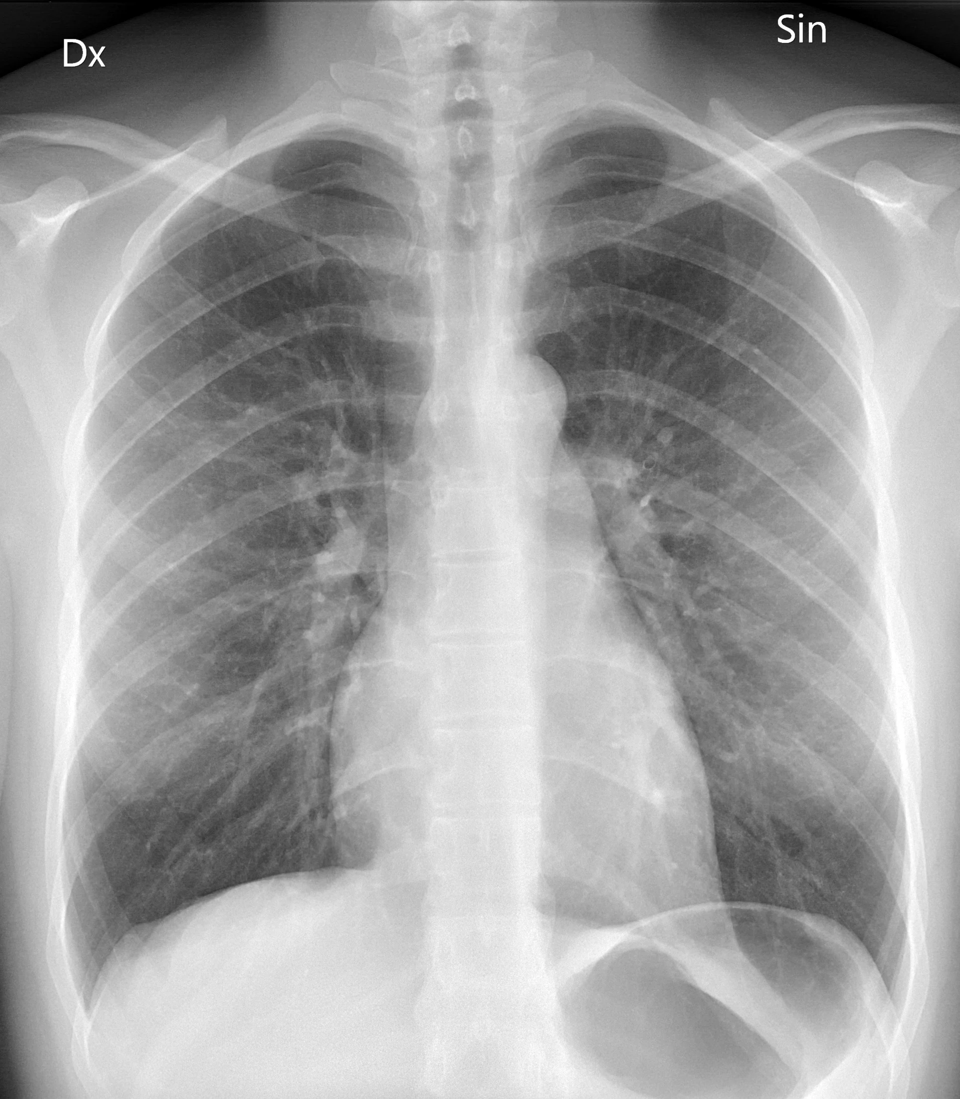 Radiografía posteroanterior de tórax procesada por el pipeline Med-IA